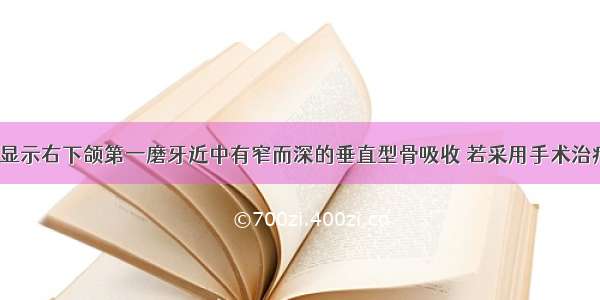 如果X线片显示右下颌第一磨牙近中有窄而深的垂直型骨吸收 若采用手术治疗 最理想的